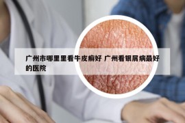 广州市哪里里看牛皮癣好 广州看银屑病最好的医院