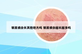 银屑病会长其他地方吗 银屑病会越长越多吗