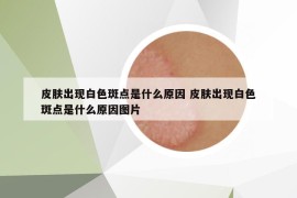 皮肤出现白色斑点是什么原因 皮肤出现白色斑点是什么原因图片