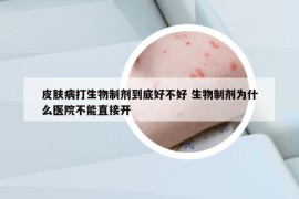 皮肤病打生物制剂到底好不好 生物制剂为什么医院不能直接开