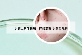 小腹上长了像癣一样的东西 小腹出现藓