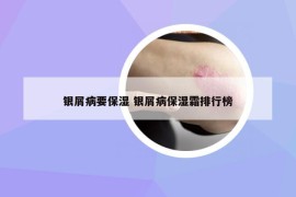 银屑病要保湿 银屑病保湿霜排行榜