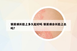 银屑病长脸上多久能好吗 银屑病会长脸上去吗?