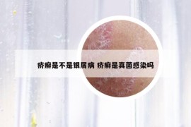 疥癣是不是银屑病 疥癣是真菌感染吗