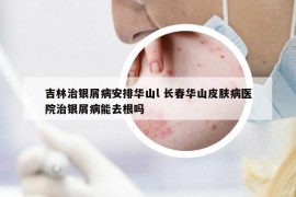 吉林治银屑病安排华山l 长春华山皮肤病医院治银屑病能去根吗