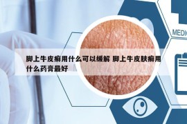 脚上牛皮癣用什么可以缓解 脚上牛皮肤癣用什么药膏最好