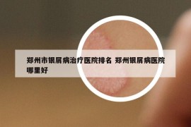郑州市银屑病治疗医院排名 郑州银屑病医院哪里好