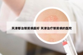 天津那治银屑病最好 天津治疗银屑病的医院