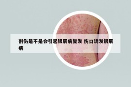 割伤是不是会引起银屑病复发 伤口诱发银屑病