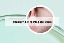 牛皮癣能三七不 牛皮癣患者可以吃吗