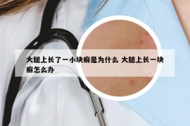 大腿上长了一小块癣是为什么 大腿上长一块癣怎么办
