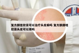 复方酮挫软膏可以治疗头皮癣吗 复方酮康唑软膏头皮可以用吗