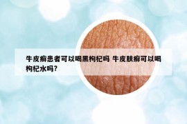 牛皮癣患者可以喝黑枸杞吗 牛皮肤癣可以喝枸杞水吗?