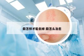 藓怎样才能去掉 藓怎么治愈