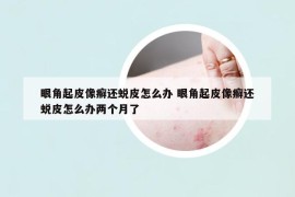 眼角起皮像癣还蜕皮怎么办 眼角起皮像癣还蜕皮怎么办两个月了