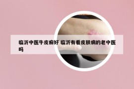 临沂中医牛皮癣好 临沂有看皮肤病的老中医吗
