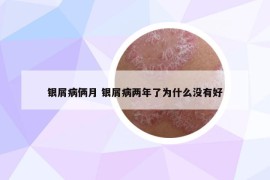 银屑病俩月 银屑病两年了为什么没有好