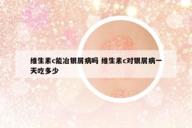 维生素c能冶银屑病吗 维生素c对银屑病一天吃多少