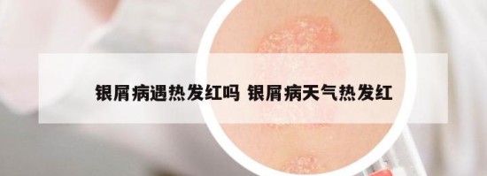 银屑病遇热发红吗 银屑病天气热发红