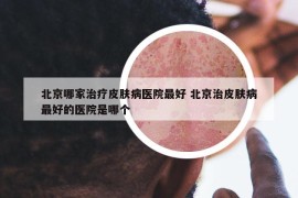北京哪家治疗皮肤病医院最好 北京治皮肤病最好的医院是哪个