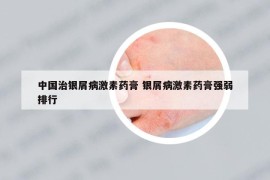 中国治银屑病激素药膏 银屑病激素药膏强弱排行