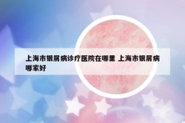 上海市银屑病诊疗医院在哪里 上海市银屑病哪家好