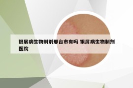 银屑病生物制剂邢台市有吗 银屑病生物制剂医院
