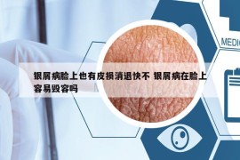 银屑病脸上也有皮损消退快不 银屑病在脸上容易毁容吗