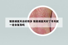 银屑病夏天会好得多 银屑病夏天好了冬天就一定会复发吗