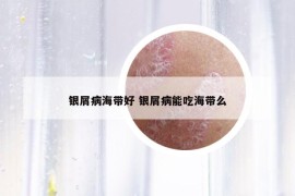 银屑病海带好 银屑病能吃海带么