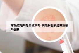 掌跖脓疱病是血液病吗 掌跖脓疱病是血液病吗图片