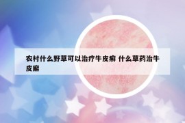 农村什么野草可以治疗牛皮癣 什么草药治牛皮廨
