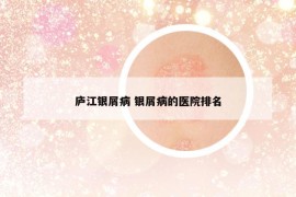庐江银屑病 银屑病的医院排名