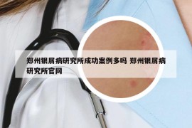 郑州银屑病研究所成功案例多吗 郑州银屑病研究所官网