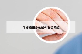牛皮癣跟身体碱性有关系吗