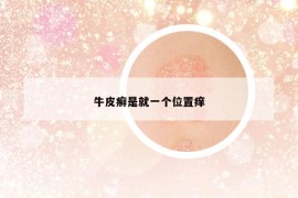 牛皮癣是就一个位置痒