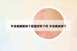 牛皮癣麟屑掉了就是好转了吗 牛皮癣皮掉了