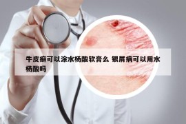 牛皮癣可以涂水杨酸软膏么 银屑病可以用水杨酸吗