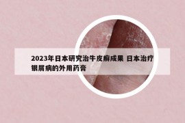 2023年日本研究治牛皮癣成果 日本治疗银屑病的外用药膏