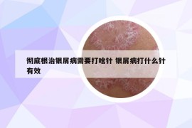彻底根治银屑病需要打啥针 银屑病打什么针有效