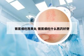 银屑病吃西黄丸 银屑病吃什么西药好使