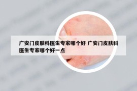 广安门皮肤科医生专家哪个好 广安门皮肤科医生专家哪个好一点