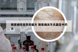 银屑病性关节炎偏方 银屑病关节炎最佳中药方