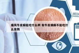 痛风牛皮癣能吃什么啊 有牛皮病癣不能吃什么食物