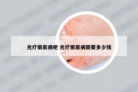 光疗银屑病吧 光疗银屑病需要多少钱