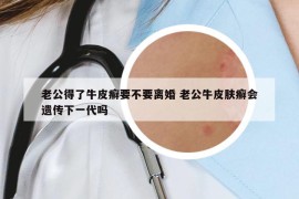 老公得了牛皮癣要不要离婚 老公牛皮肤癣会遗传下一代吗