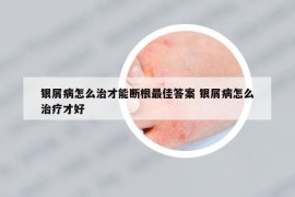 银屑病怎么治才能断根最佳答案 银屑病怎么治疗才好