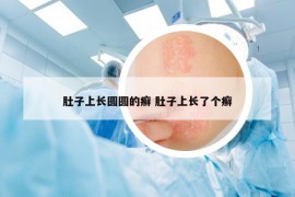 肚子上长圆圆的癣 肚子上长了个癣