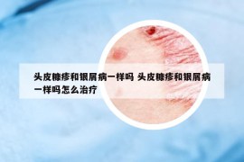 头皮糠疹和银屑病一样吗 头皮糠疹和银屑病一样吗怎么治疗