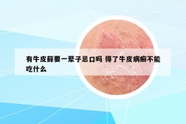 有牛皮藓要一辈子忌口吗 得了牛皮病癣不能吃什么